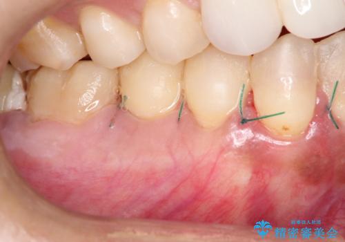 下がってしまった歯肉を元に戻したいが、自分の歯ぐきを移植するのは気が進まない : バイオマテリアルを応用した歯肉退縮への手術的対応の治療中