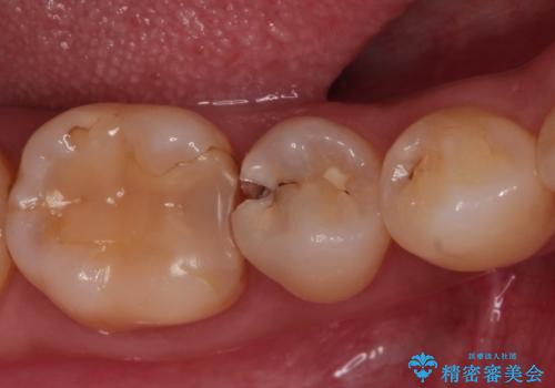 虫歯の治療 セラミックの詰め物で綺麗にの症例 治療前