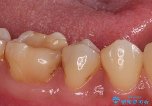 虫歯の治療 セラミックの詰め物で綺麗にの治療前