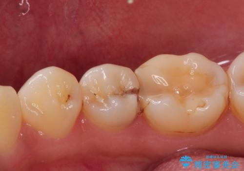 虫歯の治療 セラミックの詰め物で綺麗にの治療前