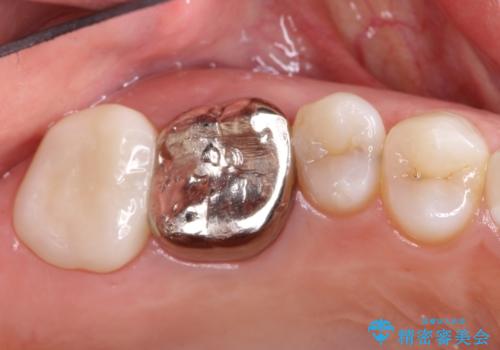 根っこの感染 再治療をしてかぶせ物を製作するの治療前