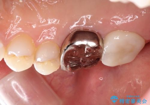 根っこの感染 再治療をしてかぶせ物を製作するの治療前