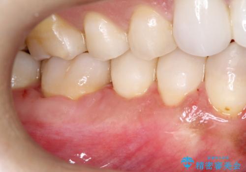 下がってしまった歯肉を元に戻したいが、自分の歯ぐきを移植するのは気が進まない : バイオマテリアルを応用した歯肉退縮への手術的対応の治療後