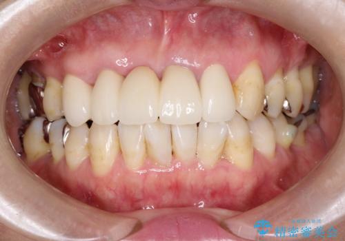 矯正を併用した前歯のセラミックブリッジ治療の症例 治療後