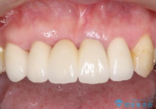 矯正を併用した前歯のセラミックブリッジ治療の治療後