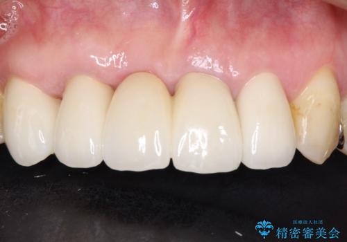 矯正を併用した前歯のセラミックブリッジ治療の治療後
