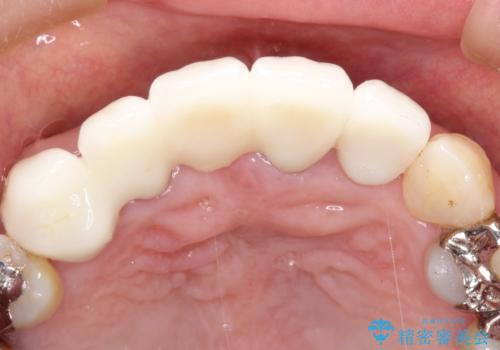 矯正を併用した前歯のセラミックブリッジ治療の治療後
