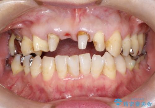 矯正を併用した前歯のセラミックブリッジ治療の治療中