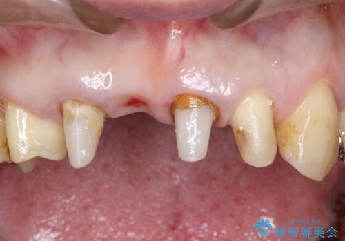 矯正を併用した前歯のセラミックブリッジ治療の治療中