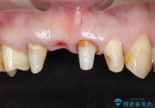 矯正を併用した前歯のセラミックブリッジ治療の治療中