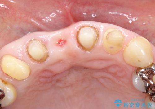 矯正を併用した前歯のセラミックブリッジ治療の治療中