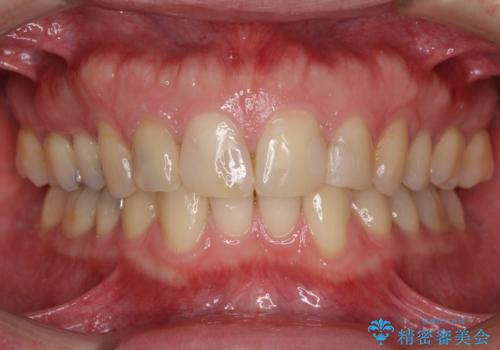 前歯のつめものが汚い セラミックできれいにの治療前