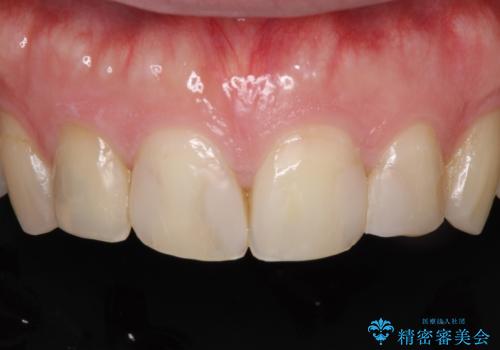 前歯のつめものが汚い セラミックできれいにの症例 治療前