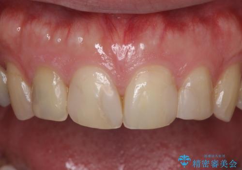 前歯のつめものが汚い セラミックできれいにの治療前