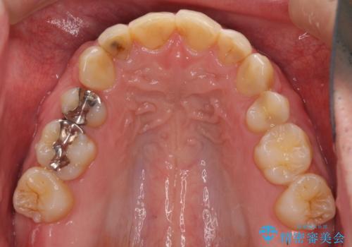 前歯のつめものが汚い セラミックできれいにの治療前