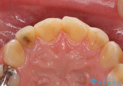 前歯のつめものが汚い セラミックできれいにの治療前