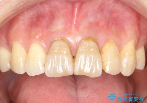 変色した前歯をセラミックできれいに　レイヤリングセラミックの治療前