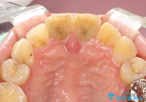 変色した前歯をセラミックできれいに レイヤリングセラミックの治療前