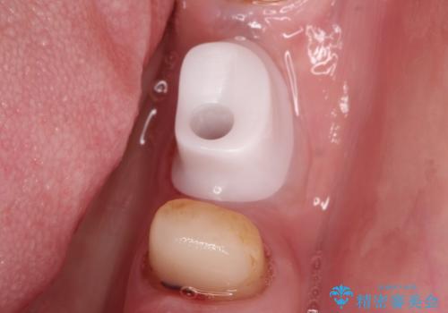 骨が薄い部位への骨造成をともなうインプラントの治療中