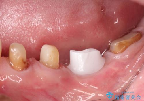 骨が薄い部位への骨造成をともなうインプラントの治療中