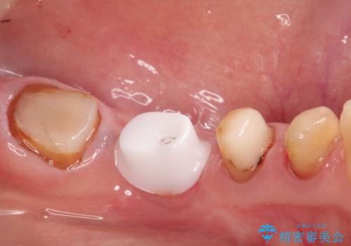 骨が薄い部位への骨造成をともなうインプラントの治療中