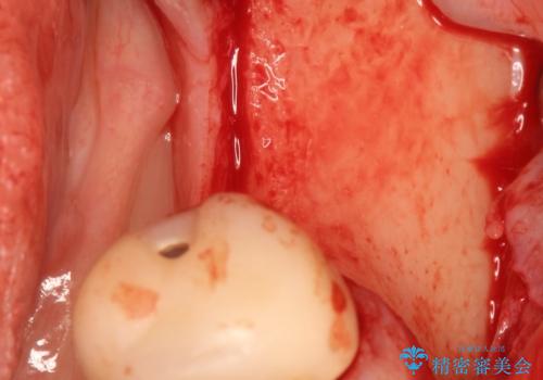 骨が薄い部位への骨造成をともなうインプラントの治療前