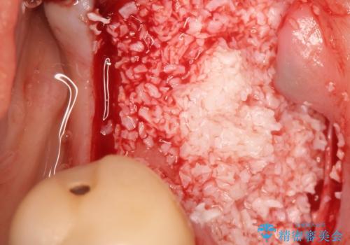 骨が薄い部位への骨造成をともなうインプラントの治療前