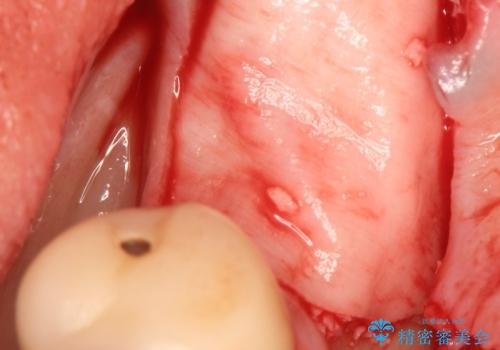 骨が薄い部位への骨造成をともなうインプラントの治療前