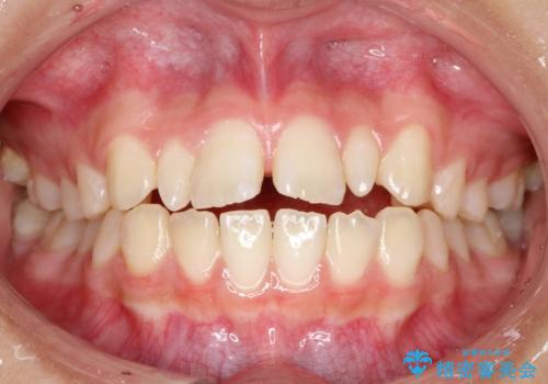 歯の形態修正も含めた矯正治療&セラミック治療の症例 治療前