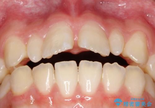 歯の形態修正も含めた矯正治療&セラミック治療の治療前