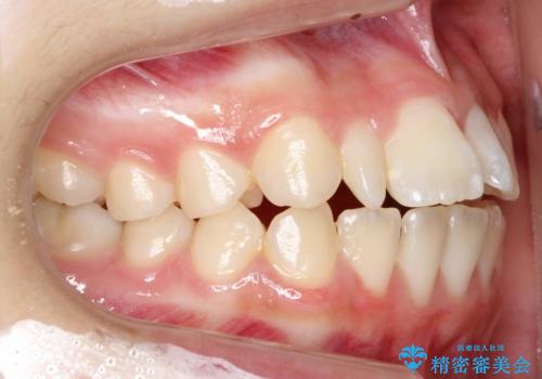 歯の形態修正も含めた矯正治療&セラミック治療の治療前