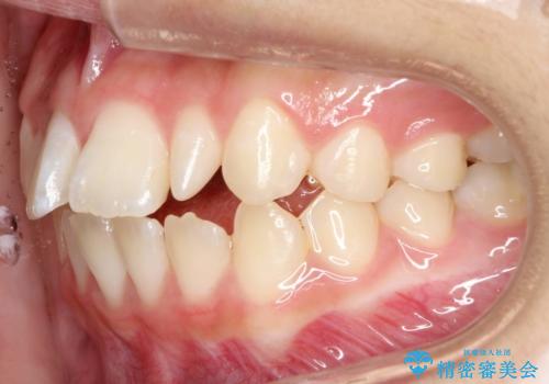 歯の形態修正も含めた矯正治療&セラミック治療の治療前