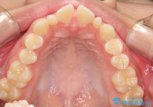 歯の形態修正も含めた矯正治療&セラミック治療の治療前