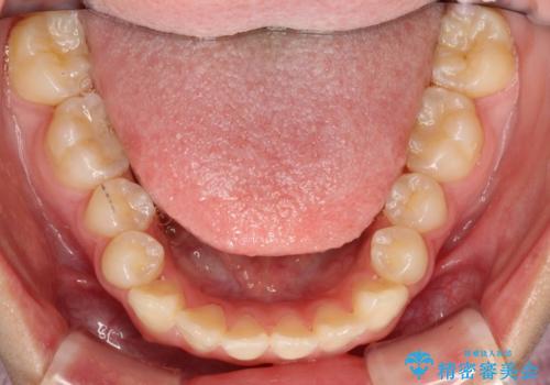 歯の形態修正も含めた矯正治療&セラミック治療の治療前