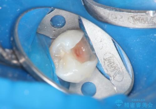 虫歯の治療 セラミックの詰め物で綺麗にの治療中