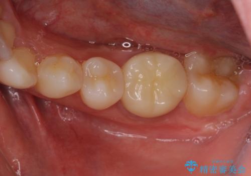 海外転勤前にセラミック治療の治療後