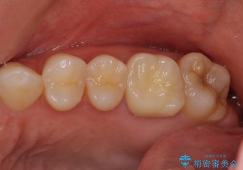 海外転勤前にセラミック治療の治療後