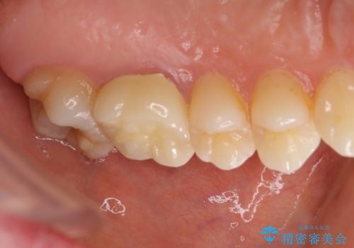 海外転勤前にセラミック治療の治療後