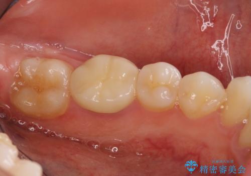 海外転勤前にセラミック治療の治療後