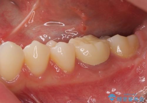 海外転勤前にセラミック治療の治療後