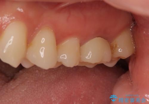海外転勤前にセラミック治療の治療後
