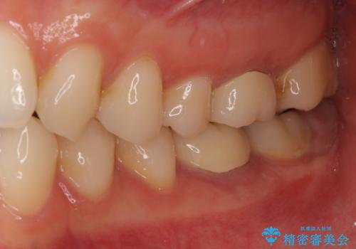 海外転勤前にセラミック治療