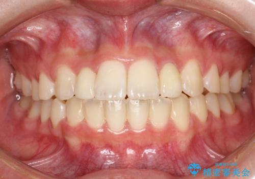 歯の形態修正も含めた矯正治療&セラミック治療の症例 治療後