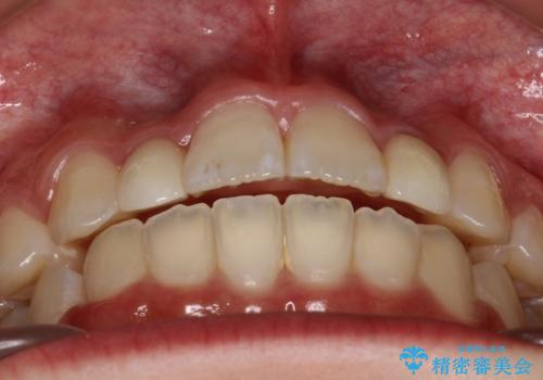 歯の形態修正も含めた矯正治療&セラミック治療の治療後
