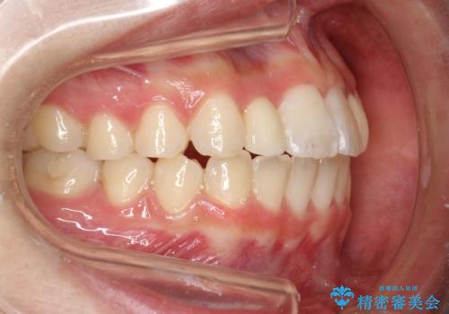 歯の形態修正も含めた矯正治療&セラミック治療の治療後