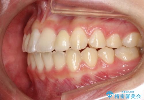 歯の形態修正も含めた矯正治療&セラミック治療の治療後