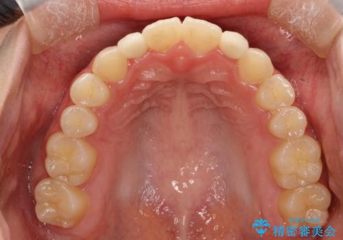 歯の形態修正も含めた矯正治療&セラミック治療の治療後