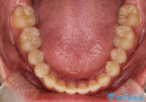 歯の形態修正も含めた矯正治療&セラミック治療の治療後