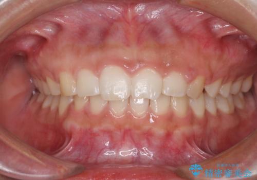 気になる出っ歯とすきっ歯をインビザラインで改善の症例 治療後
