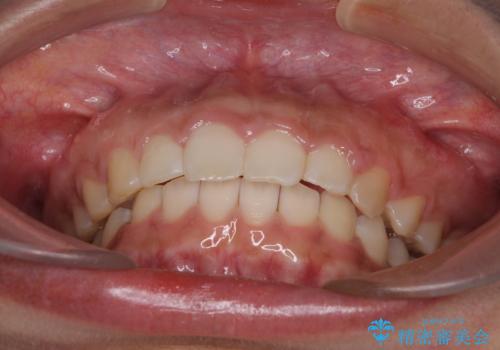 気になる出っ歯とすきっ歯をインビザラインで改善の治療後